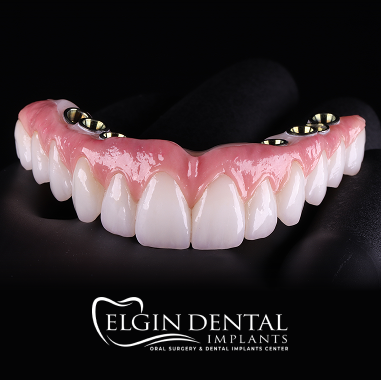 Hybrid Implant Bridge