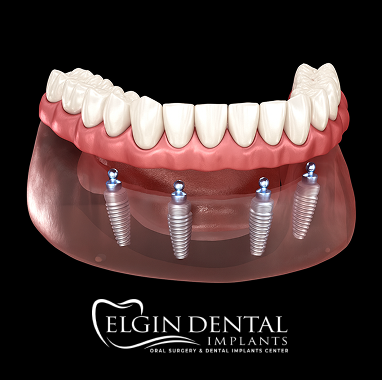 Zirconia Implant Bridge