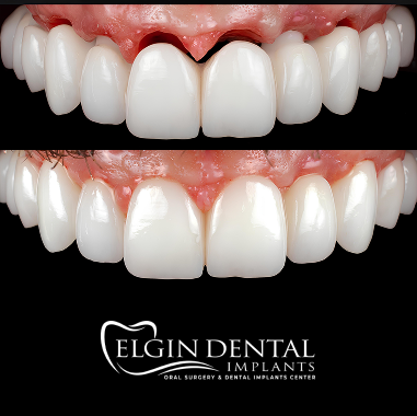 Porcelain Implant Bridge